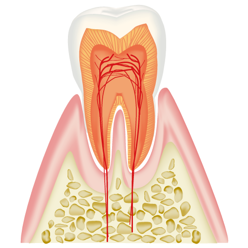 歯の神経をとったのになぜ歯が痛くなるの？