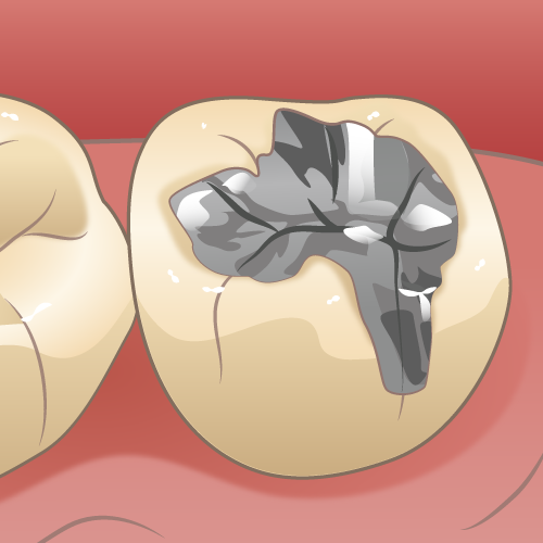 銀歯は銀でできている？