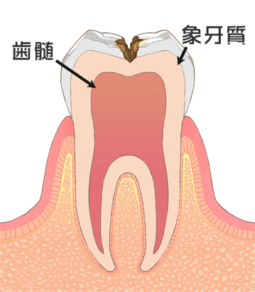 左京区　歯医者　金田歯科医院　虫歯