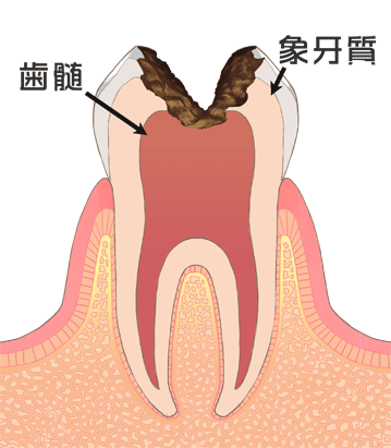 歯の中の神経を取った後の歯の治療はどうなるの?②