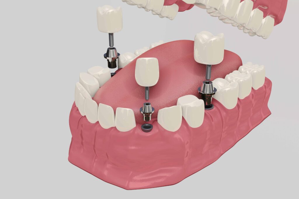 インプラントの歯の模型