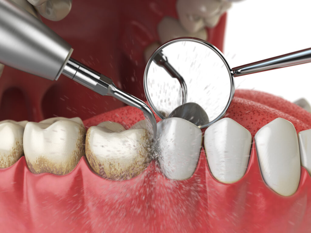 歯石を除去する治療