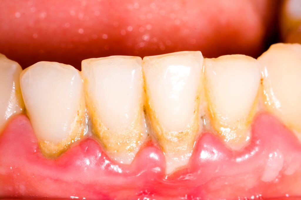 歯石のついた歯
