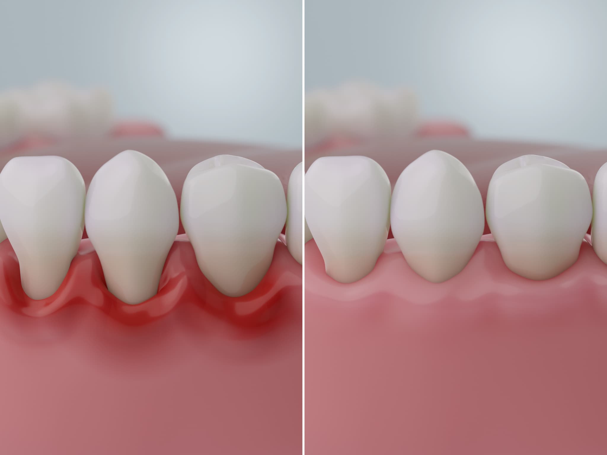 歯周病の進行を表すイメージ