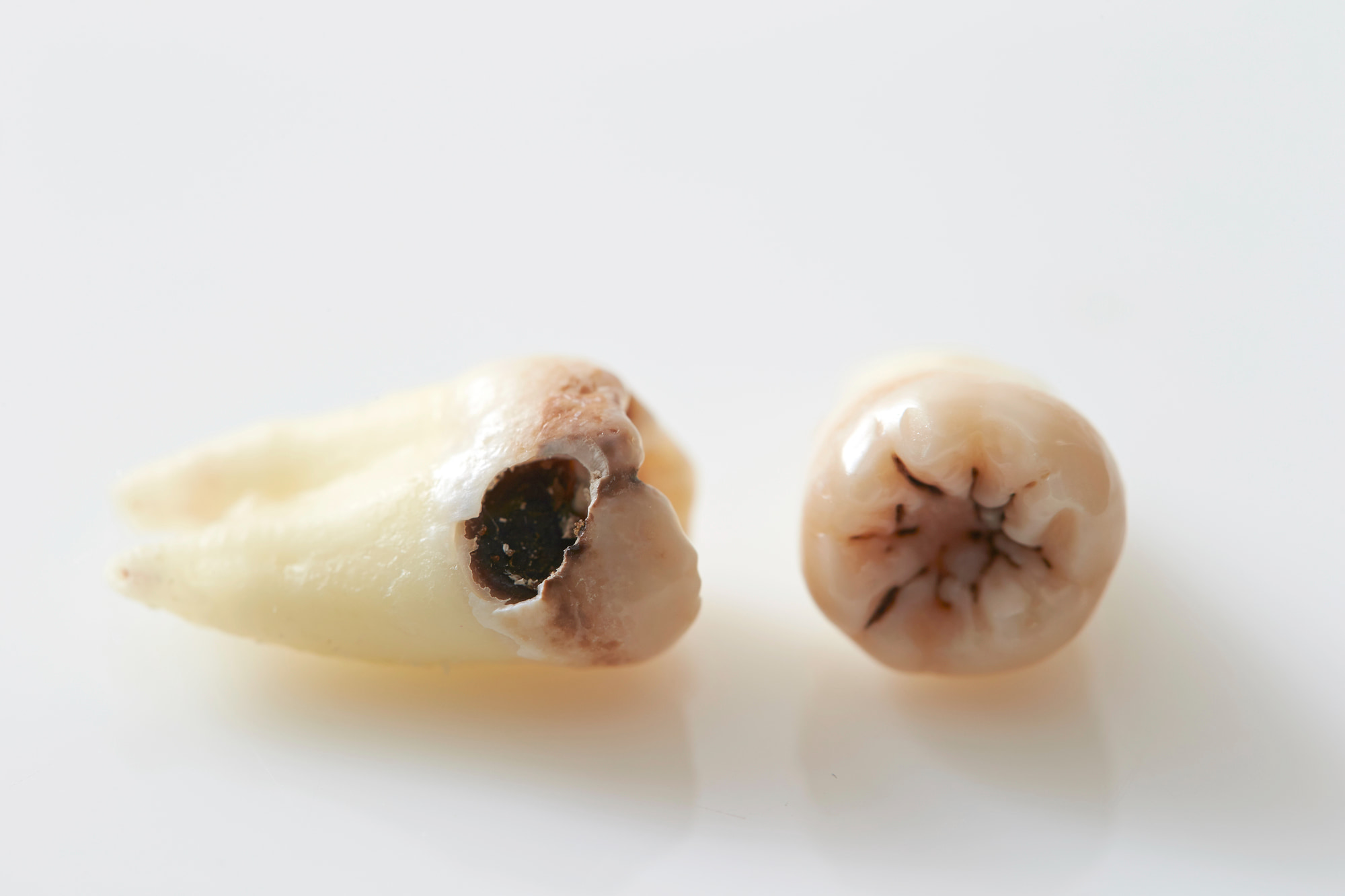 虫歯になった親知らずのイメージ
