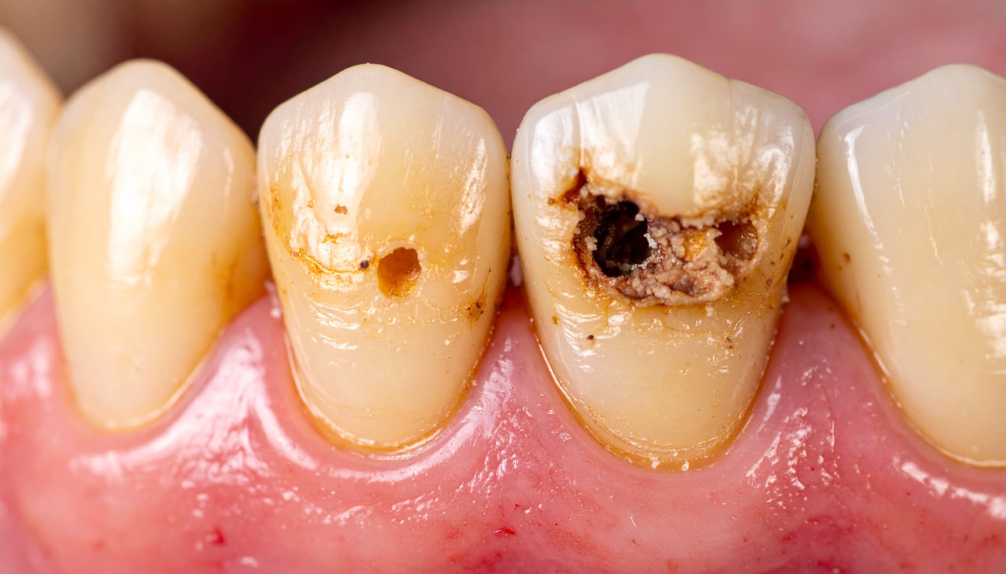 歯垢を放置して虫歯になった歯