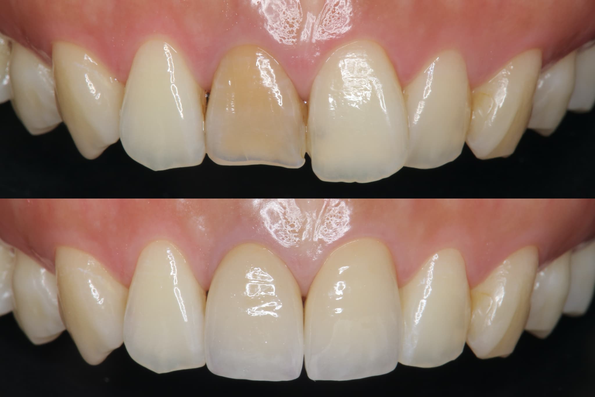 審美歯科で治療する前後の前歯のイメージ