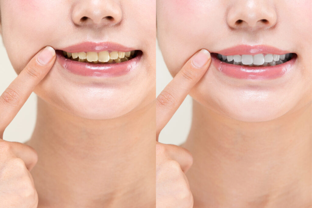 ホワイトニングをして綺麗になった歯