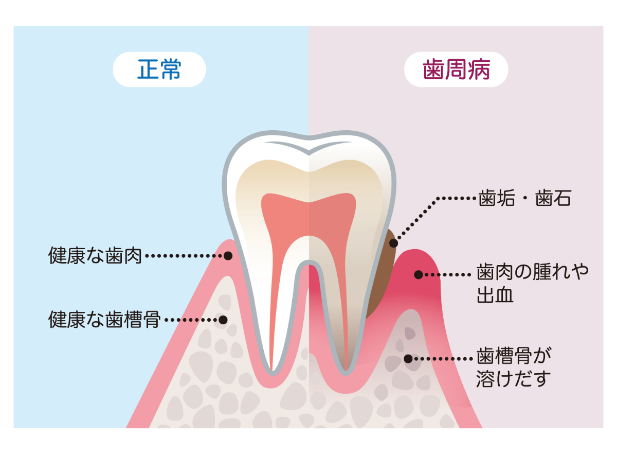 歯周病の構造