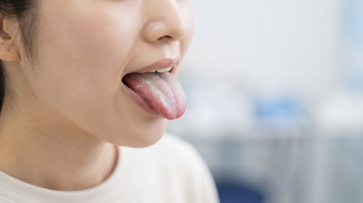 虫歯以外に考えられる口臭の原因である舌苔(ぜったい)